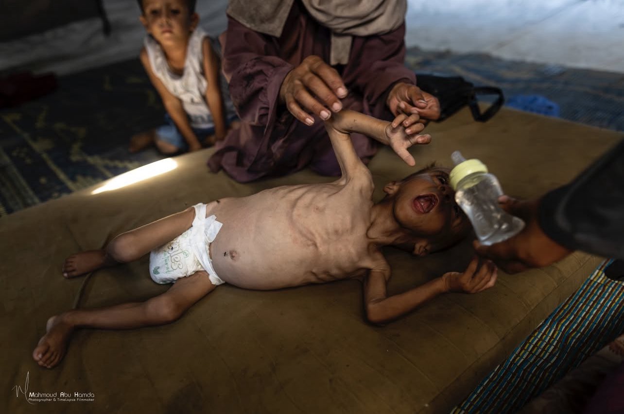 Gaza Director General: 100+ Deaths from Malnutrition
