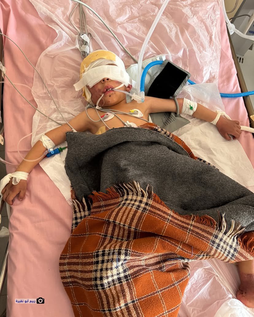 Palestinian Child Hussein Receives Treatment After Israeli Airstrike