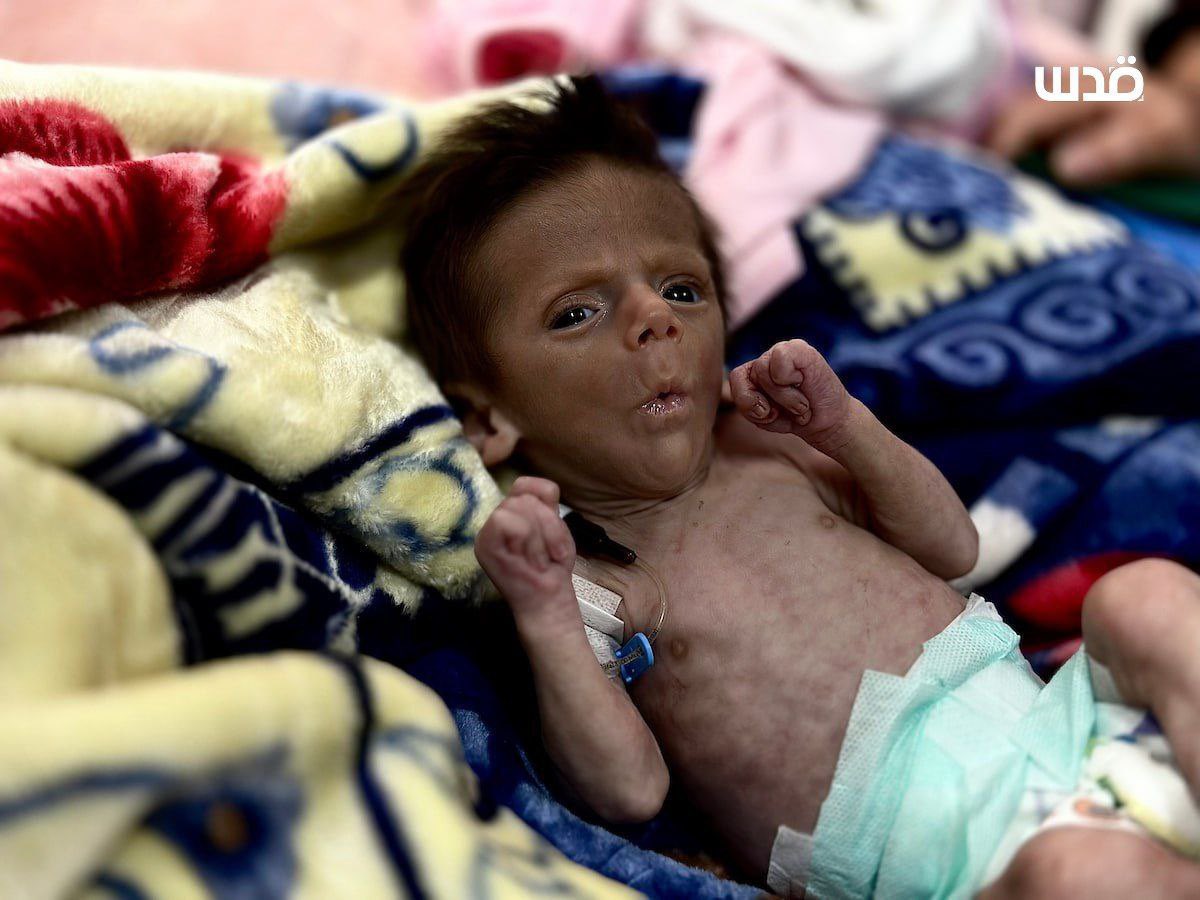 Malnourished Babies Receive Care Amid Gaza Humanitarian Crisis