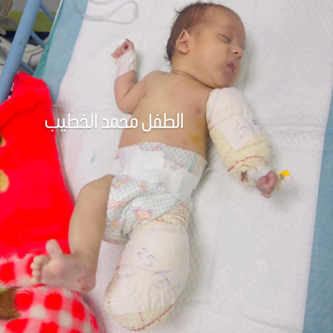 Infant Mohammed Al Khatib injured, mother killed in airstrike