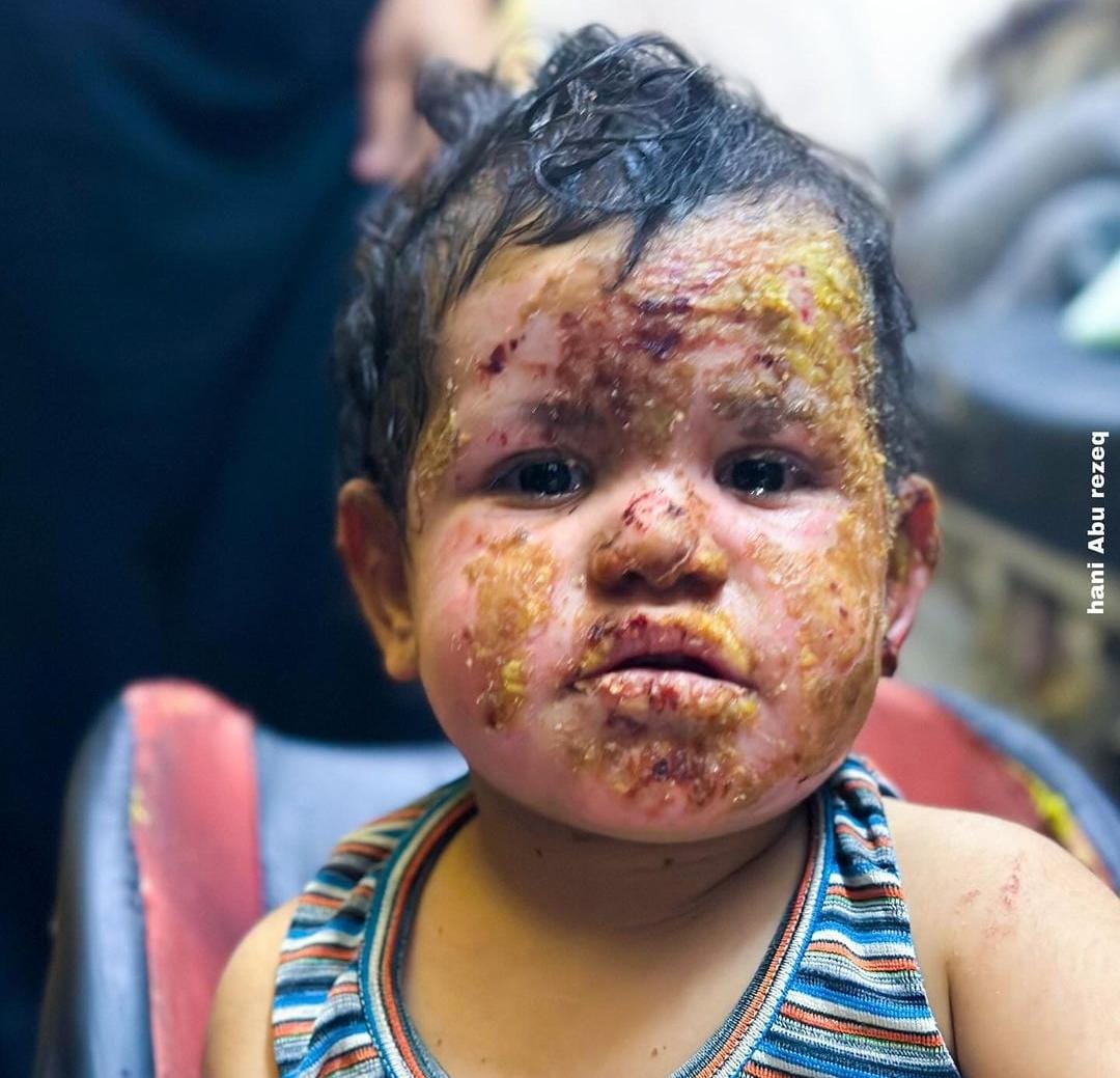 Palestinian girl and mother burned in Gaza gas cylinder explosion