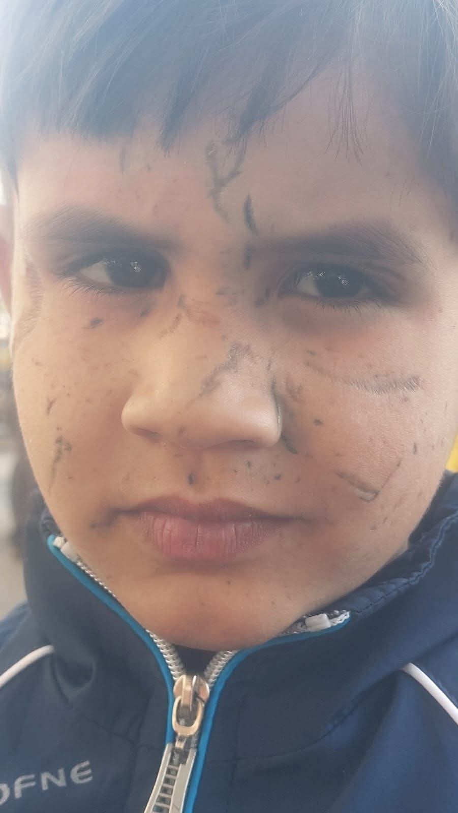 Five-year-old Adam lost eye and face in airstrike attack