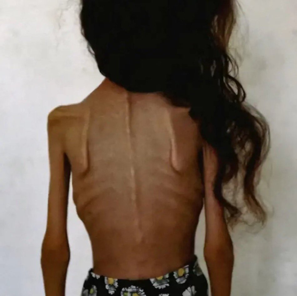 Child malnutrition case in Gaza amid food restrictions