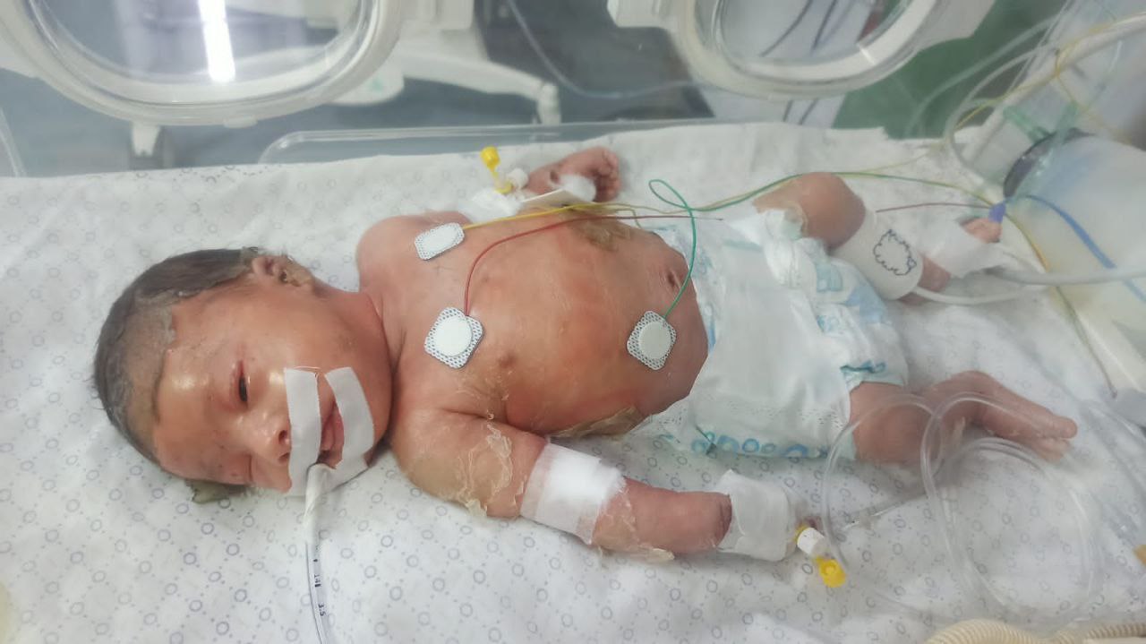 Infant injured in Israeli airstrike on Rafah house