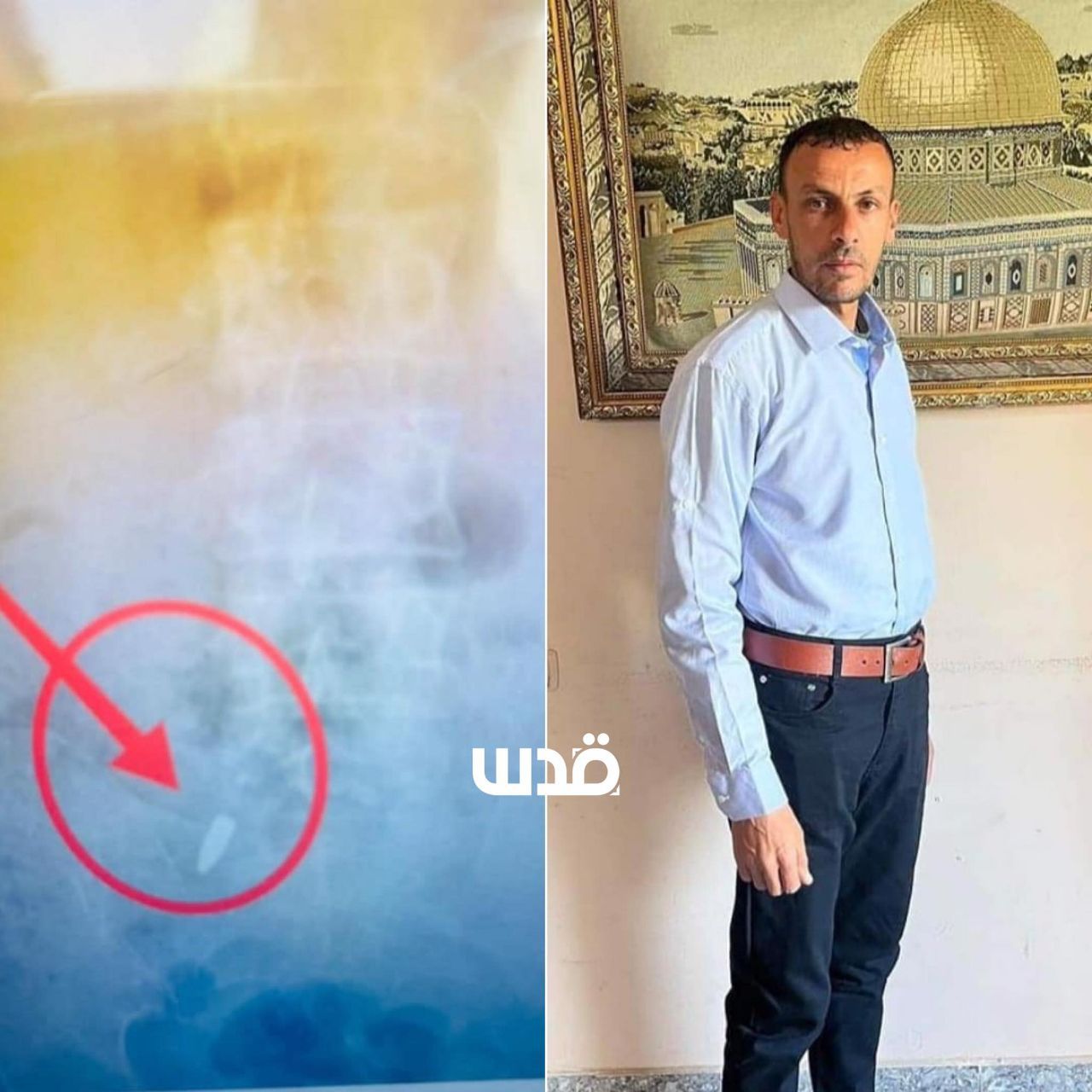 Palestinian Man Shot by Israeli Drone While Sleeping in Gaza