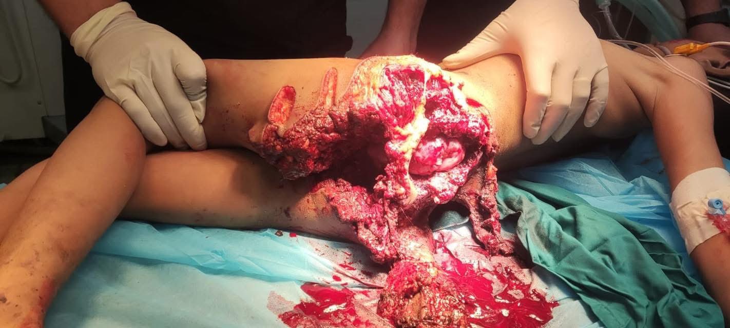 Child death in Gaza due to Israeli missile strikes and healthcare collapse