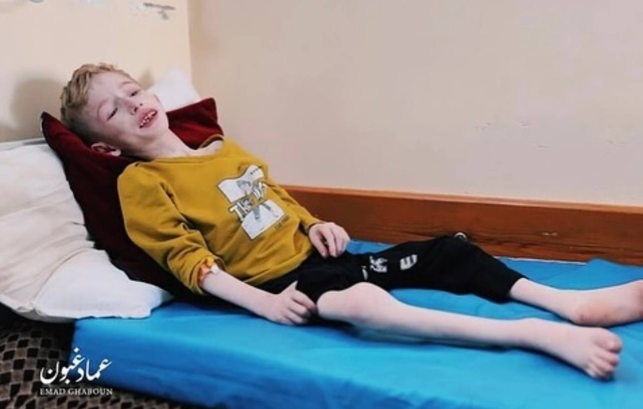 Child’s Critical Health Deterioration from Malnutrition in Gaza