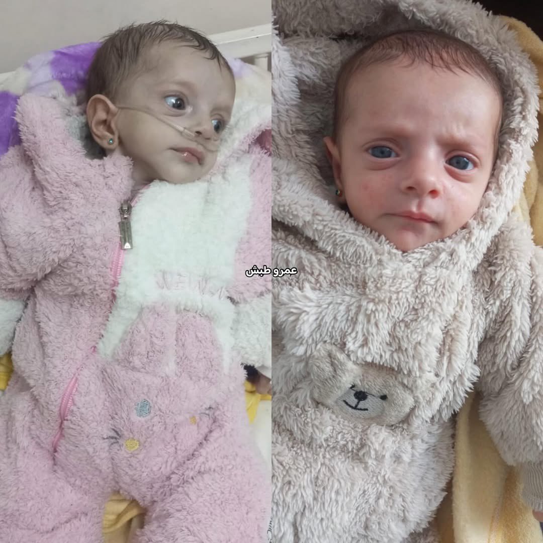 Infant in Gaza Fighting for Life from Severe Respiratory Illness