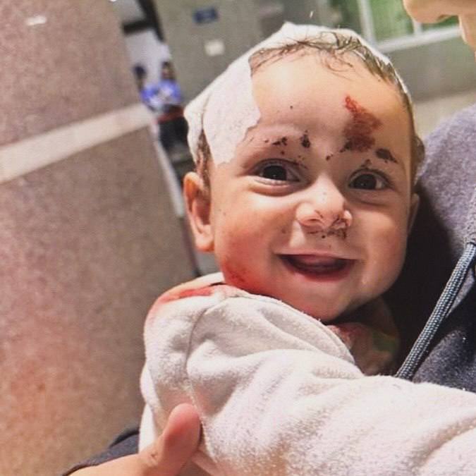 Lebanese Child Smiles Despite Injuries From Israeli Air Strike