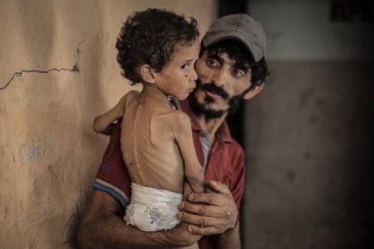 UN Reports Peak Child Hunger Crisis in Gaza
