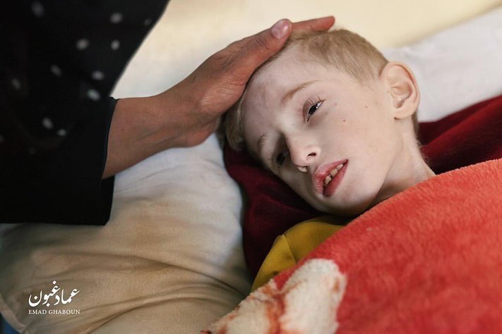 Six-year-old child Fadi Al-Zanati threatened by malnutrition and dehydration