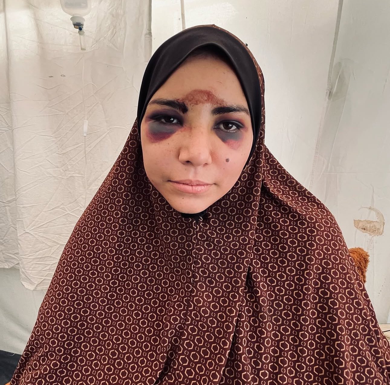 Civilian Injury from Shelling in Abu Iskander, Gaza