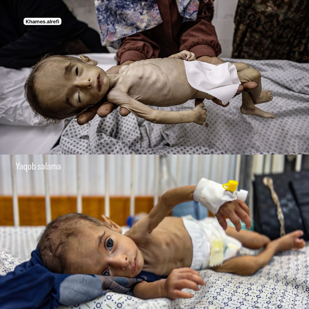 Judy, Six-Month-Old Child Dies from Starvation in Gaza