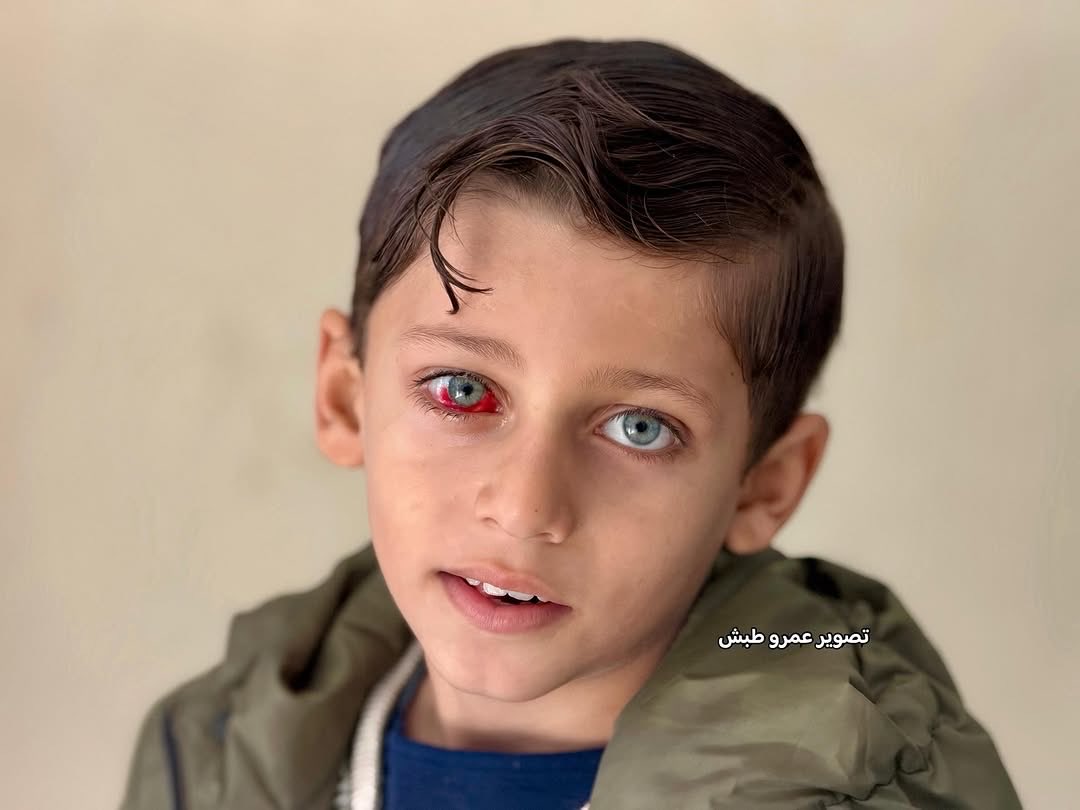 Eight-Year-Old Ali Abu Sobha Faces Vision Loss from Airstrike