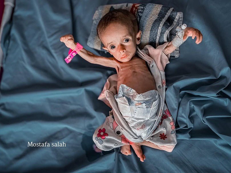 Child Malnutrition Crisis: Urgent Appeal for Humanitarian Aid