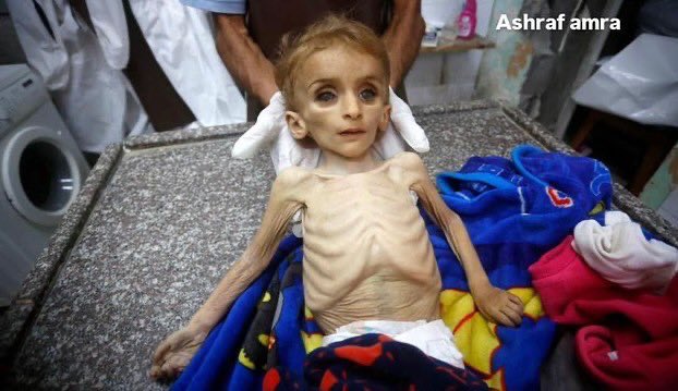 Child Dies from Malnutrition in Gaza Strip Conflict
