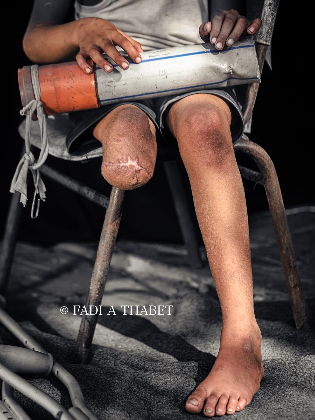 Child in Gaza Makes Prosthetic from Sewage Pipes Amid Shortages