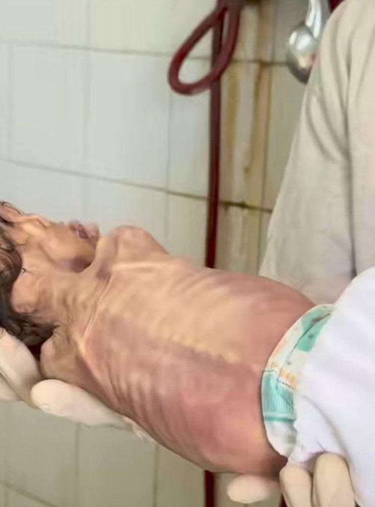 Palestinian Hunger Deaths Rise to 217 in Ongoing Crisis