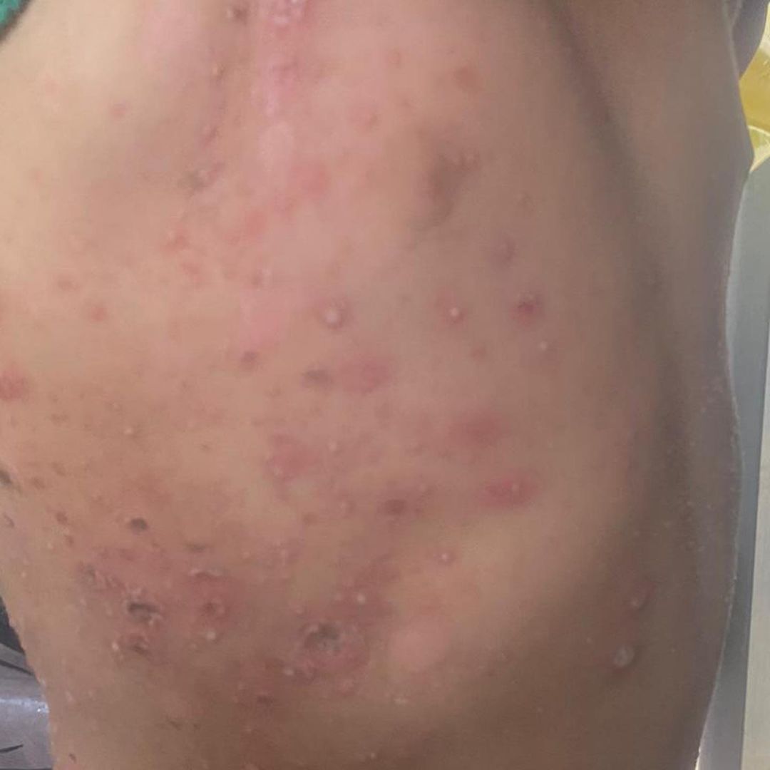 Surge in Severe Bacterial Skin Infections Among Displaced Residents