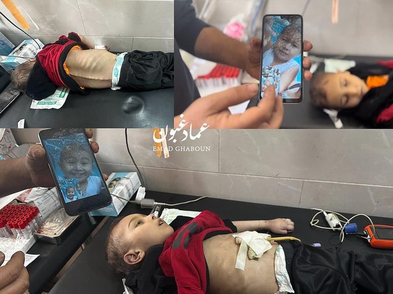 Child Mohammed Najjar Dies from Malnutrition in Northern Gaza