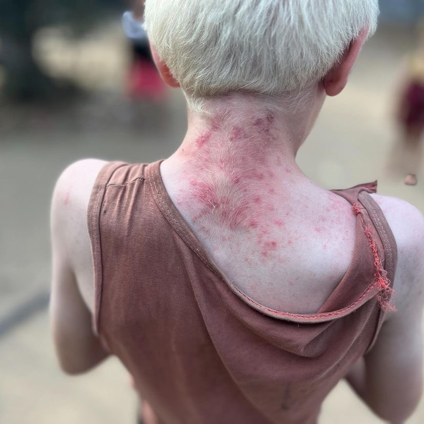 Skin Diseases Spread Among Displaced Children Due Hygiene Water Shortage