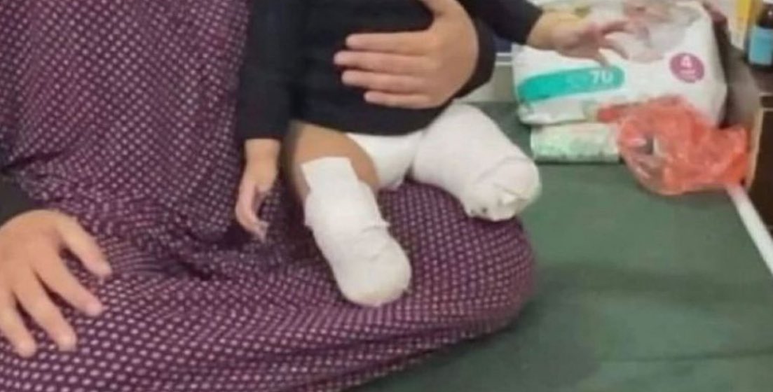 Israeli attacks cause thousands of child amputees in Gaza