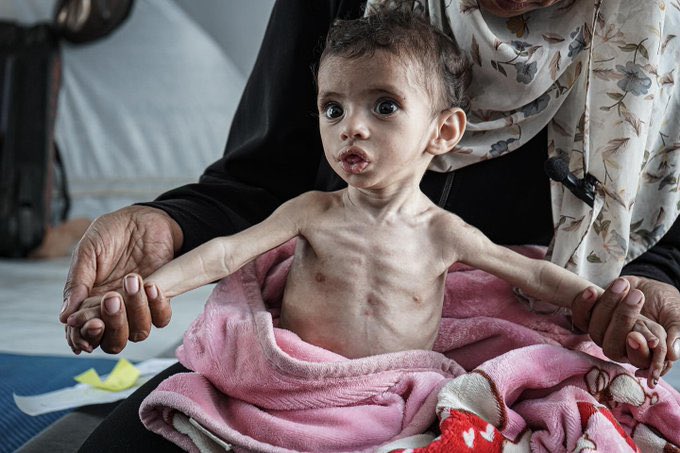 Child malnutrition in Gaza attributed to Israeli starvation policy