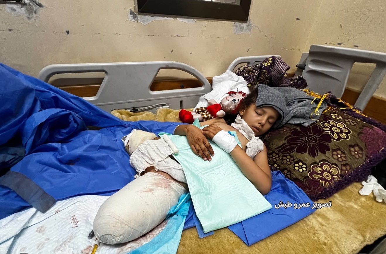 Young Girl Sila Madi Loses Second Leg After Israeli Airstrike