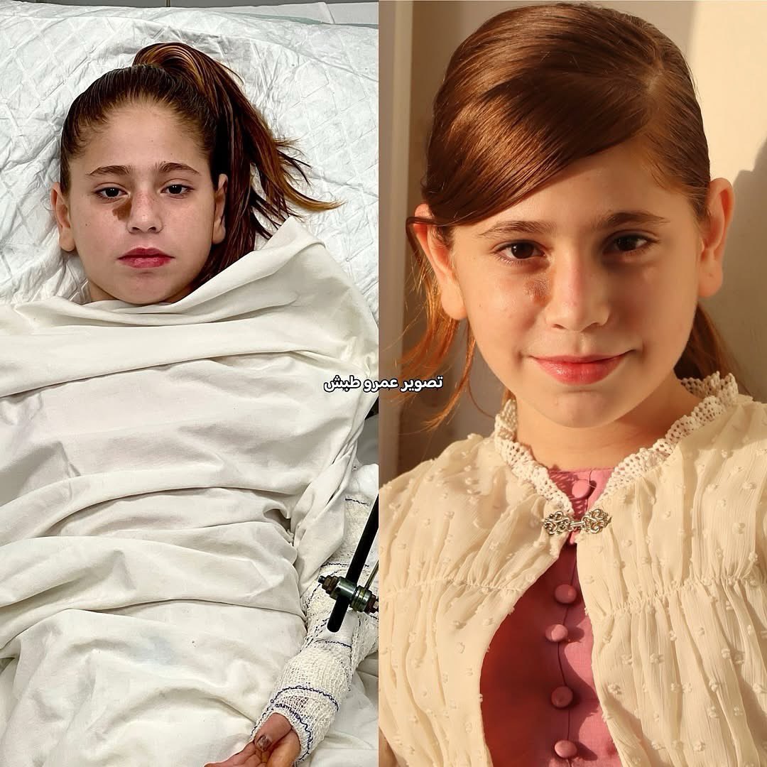 Young Palestinian Girl Fights for Life After Airstrike Injuries