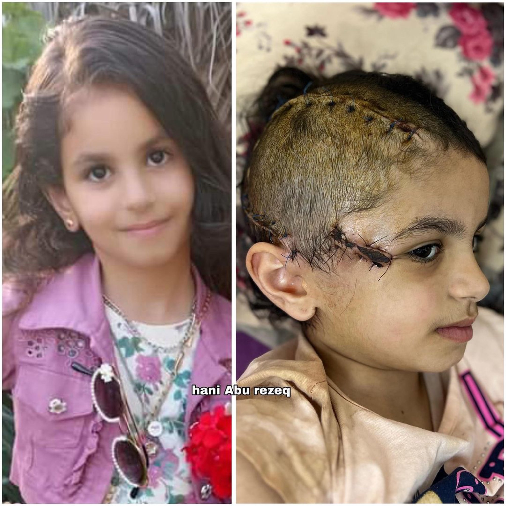 10-year-old girl paralyzed after shrapnel injury to the head