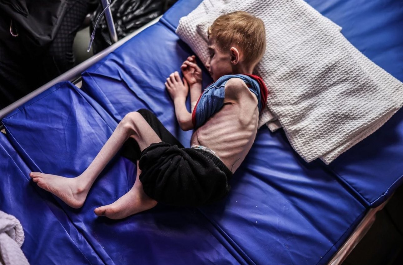 Children dying of malnutrition in northern Gaza