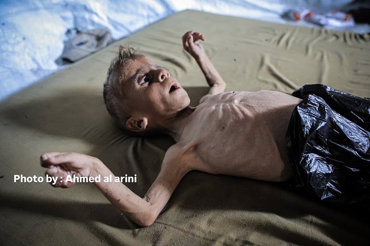 Gaza faces horrific famine with over 100 deaths from malnutrition
