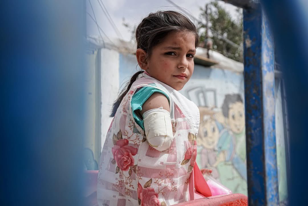 Palestinian Girl Loses Arm in Israeli Airstrike Gaza