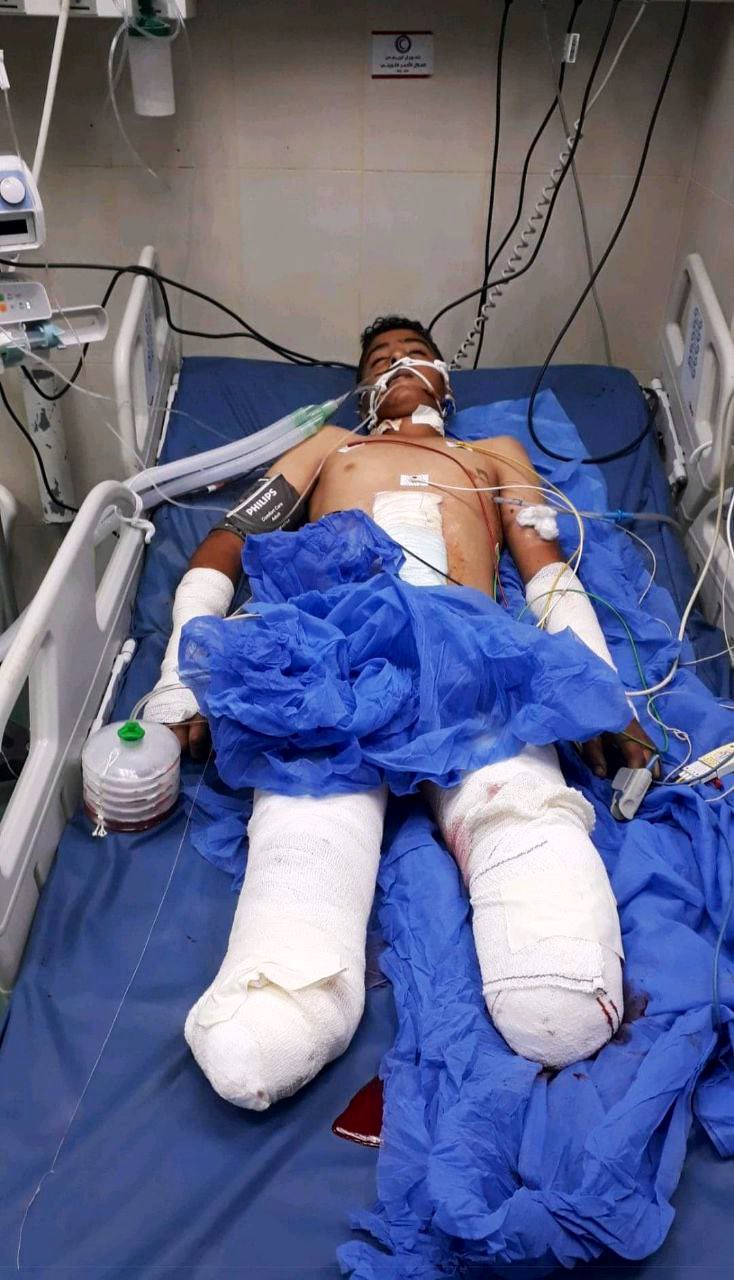 Child Ibrahim Suleiman Abu Mustafa dies after Israeli attack amputation