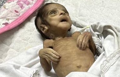 UN Reports 5,000 Children Suffering Malnutrition in Gaza