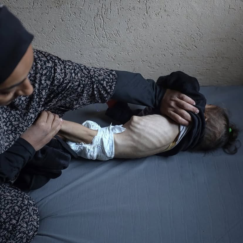 Palestinian Child Malnutrition Crisis in Gaza Strip