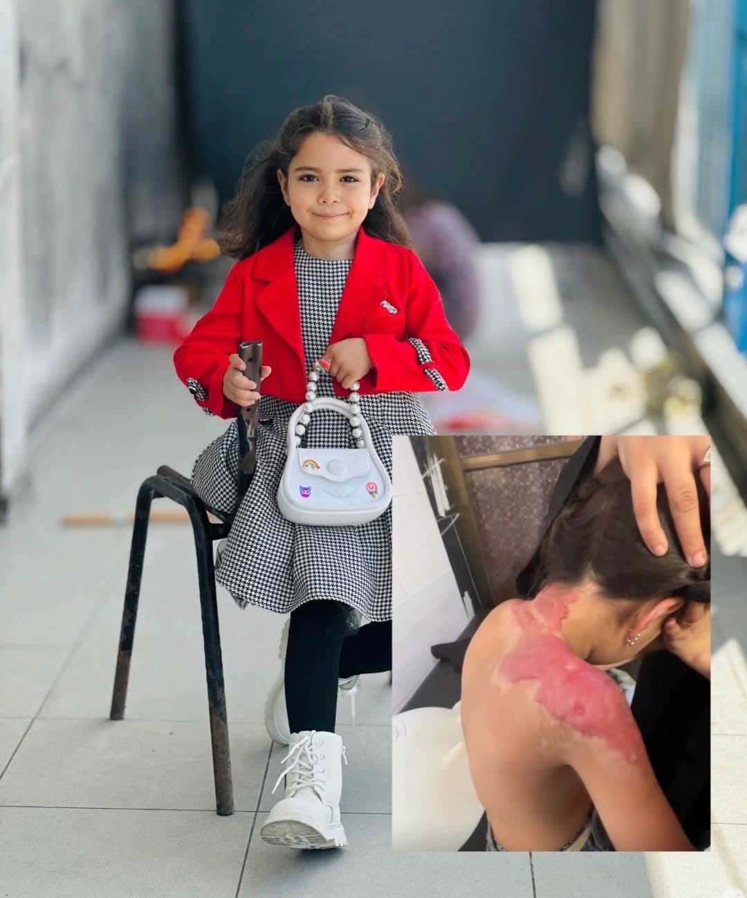 Child Shahd Al-Baz Severely Burned in Israeli Attack