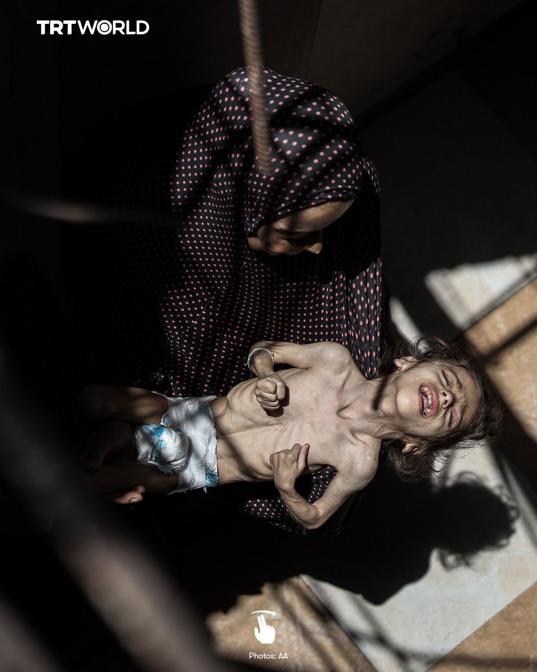 Misk al Madhoun: Malnutrition case in Gaza blockade