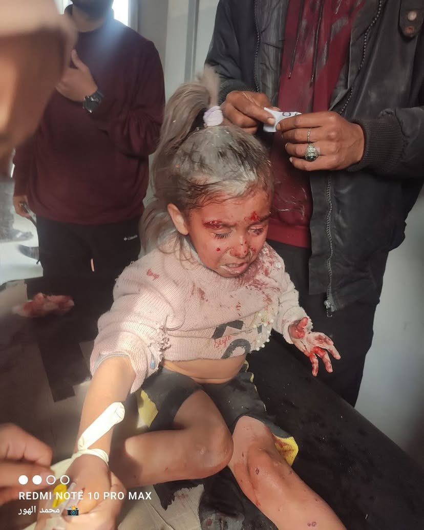 Girl Injured in Israeli Airstrikes Receives Treatment Gaza