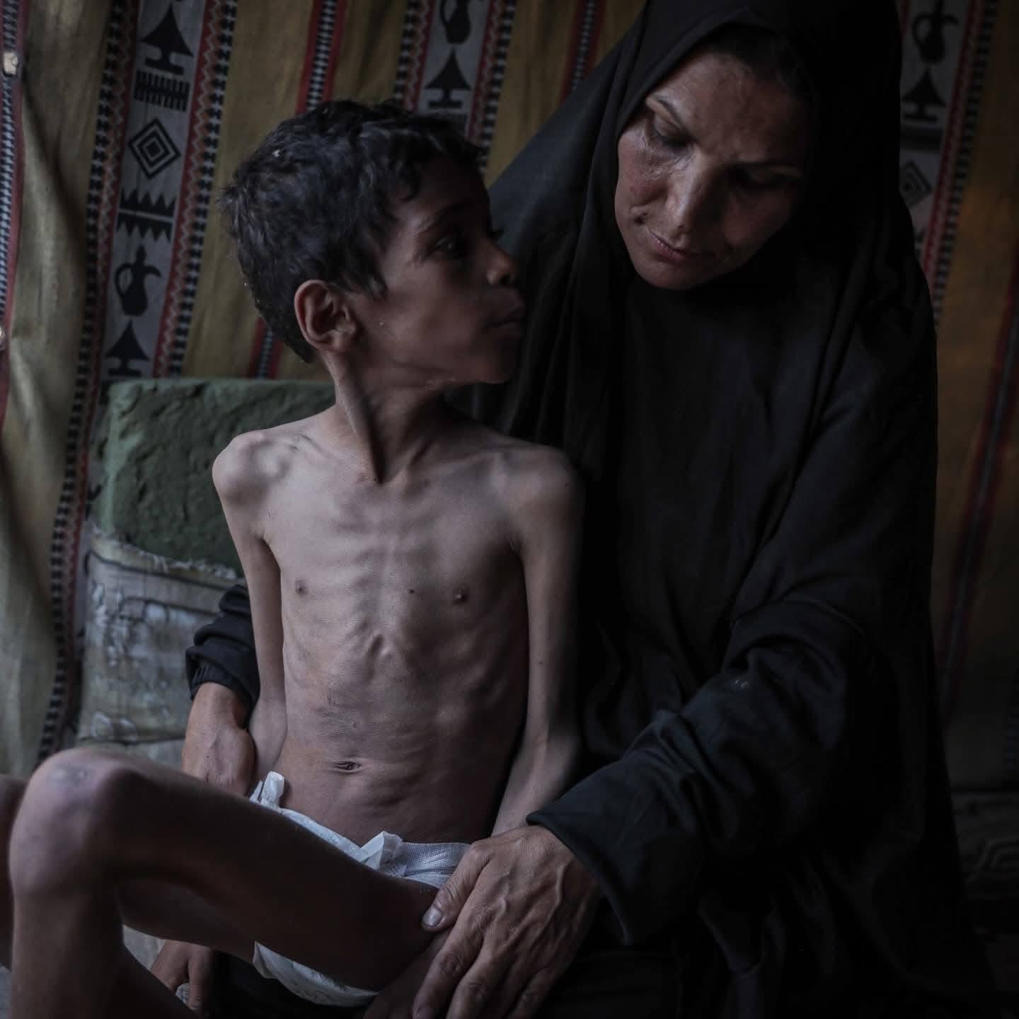 Civilians Face Severe Hunger Crisis Amid Gaza Siege Conflict