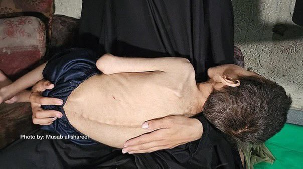 Two Brothers Risk Starvation from Cerebral Palsy Complications