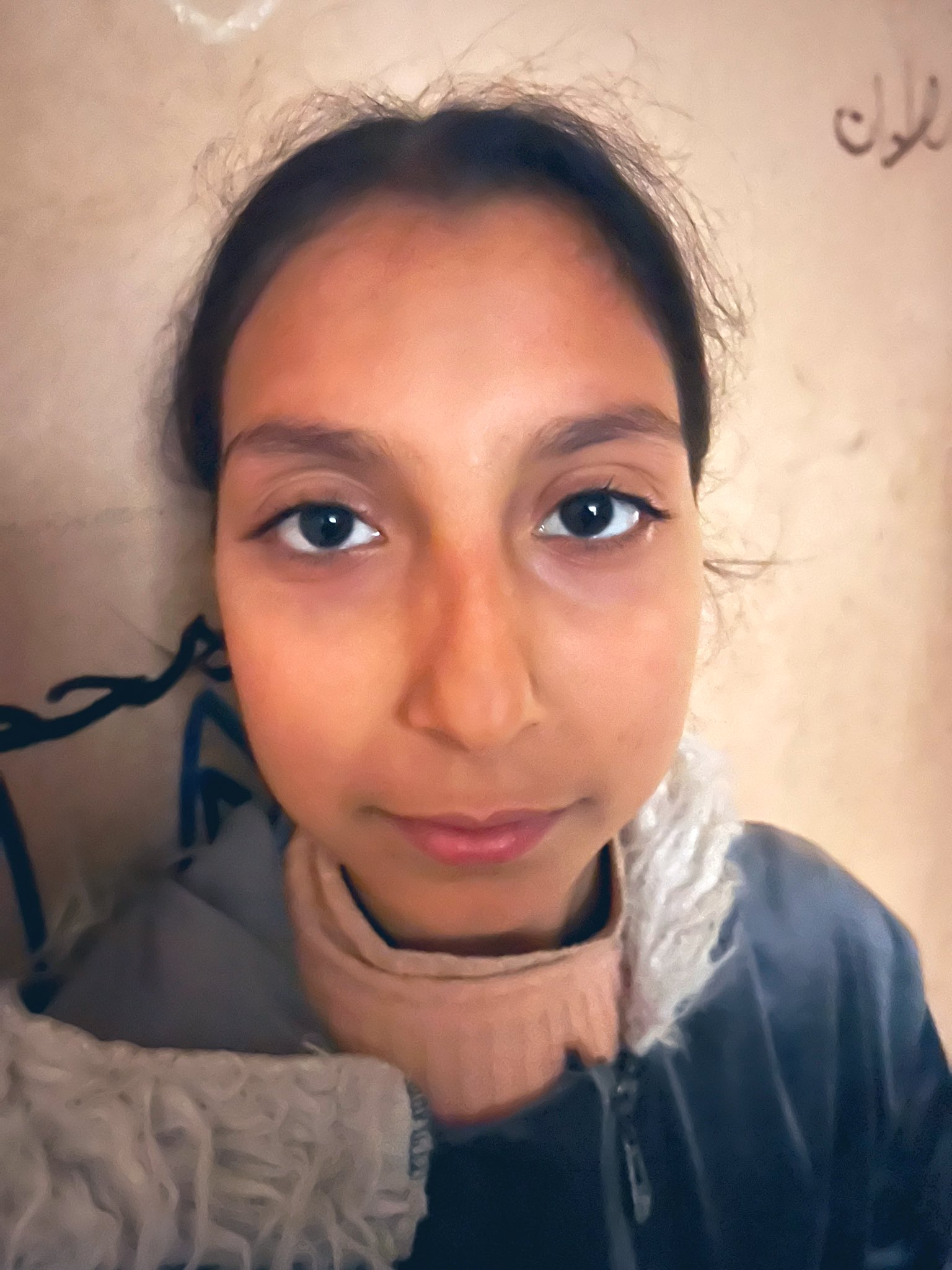 Child Malnutrition Case in Northern Gaza
