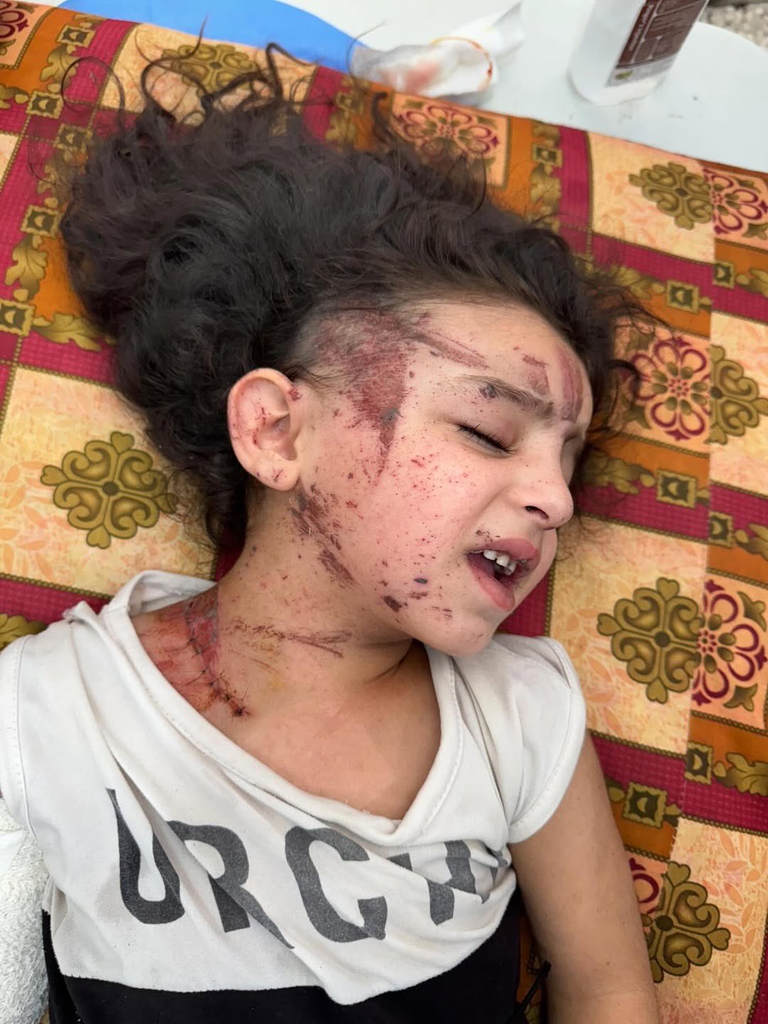 Five-Year-Old Gaza Survivor Needs Urgent Medical Aid