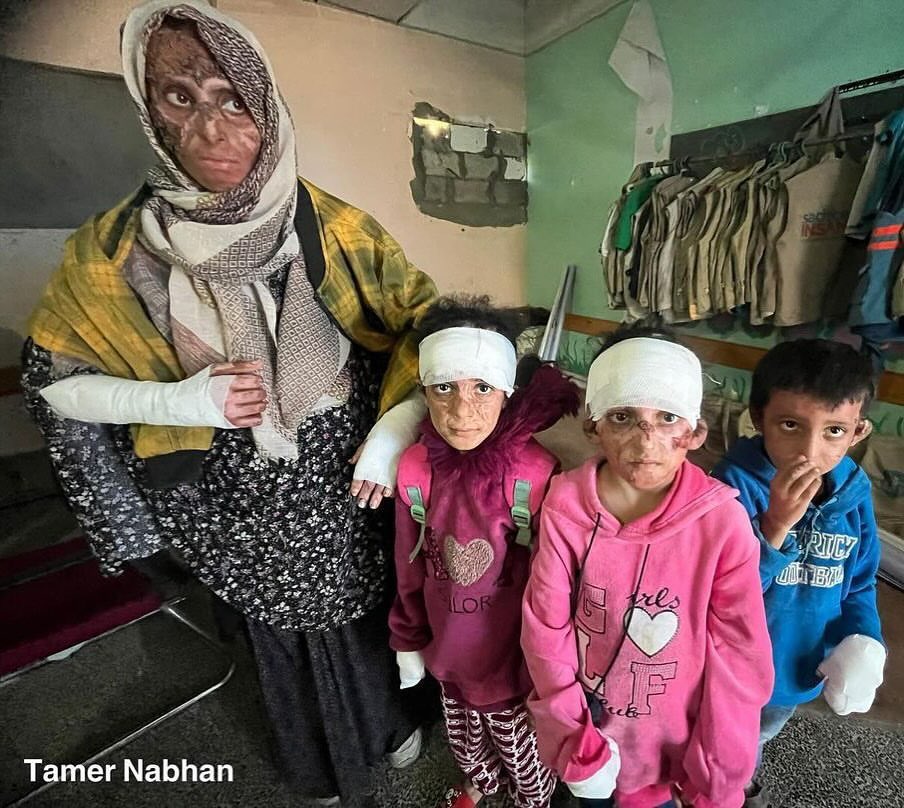Mother and children suffer burns from Israeli airstrike in Gaza