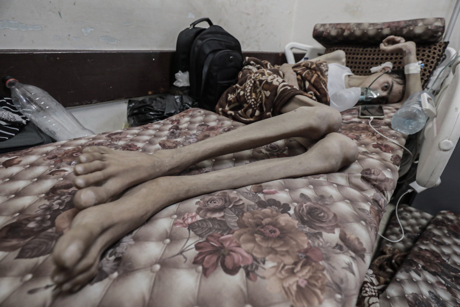 Young Palestinian man’s severe weight loss after Israeli bombing