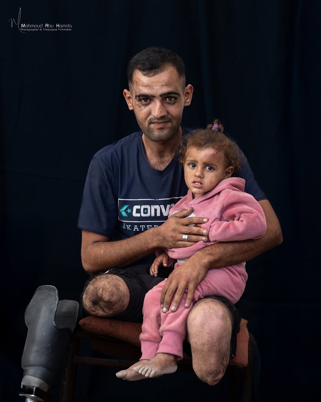 Young Man Loses Leg in Khan Younis Bombardment