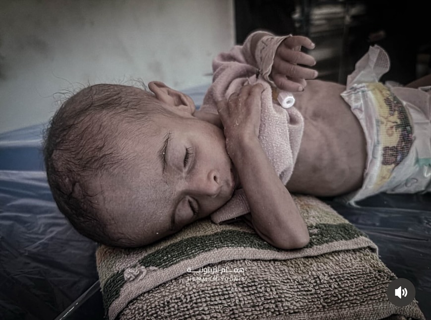 Gaza’s Children Dying from Hunger Crisis