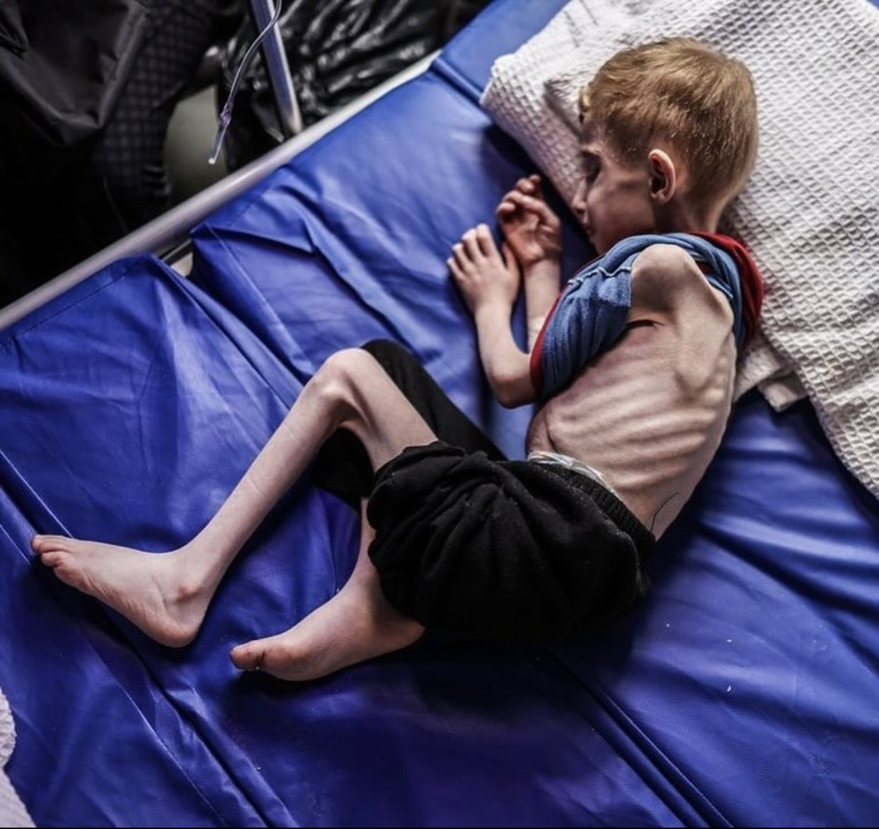 Evacuated 9-Year-Old Fadi Zant Treated for Malnutrition Amid Gaza Famine Risk