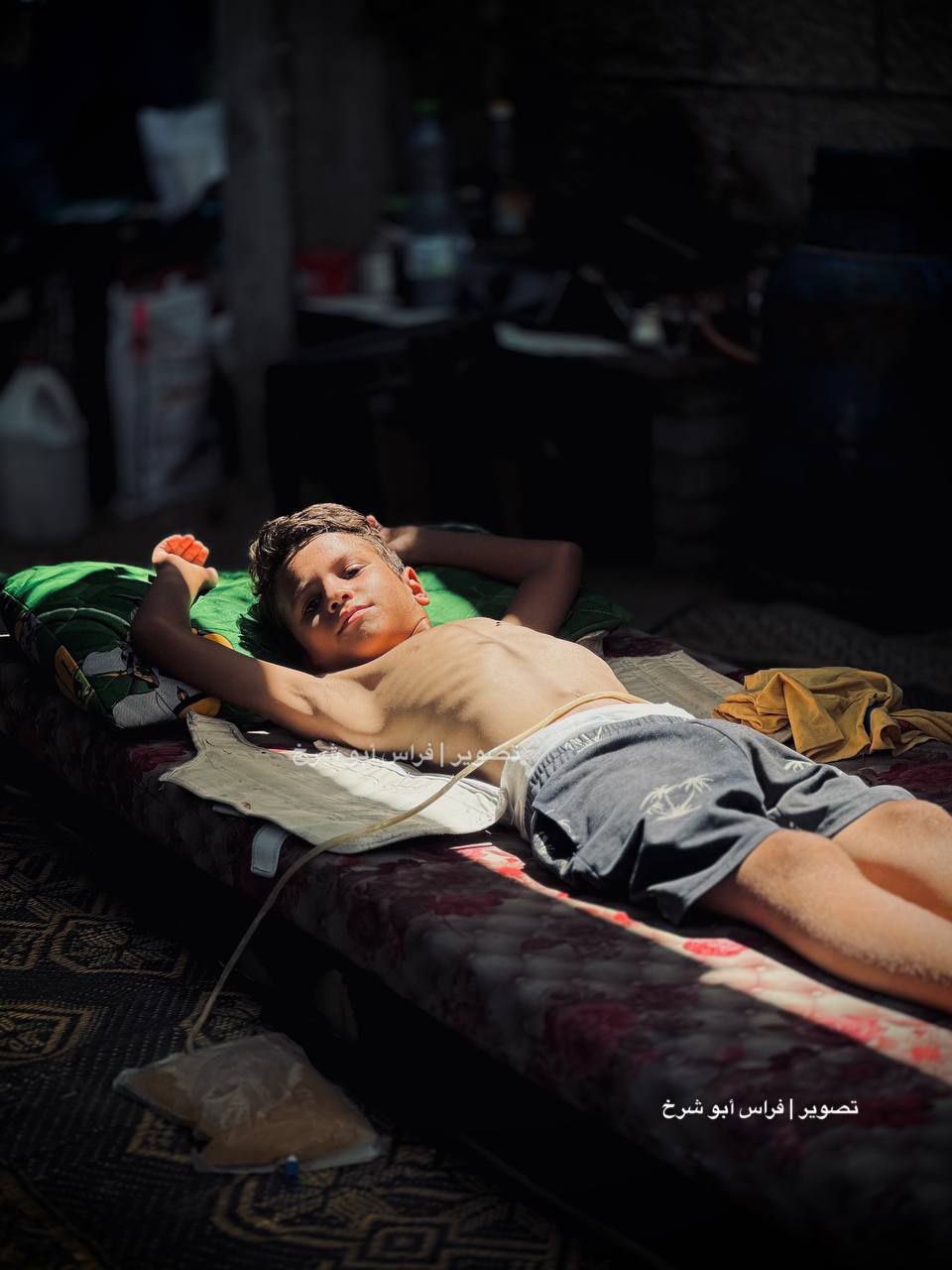 Palestinian man risks losing ability to walk after Israeli sniper shooting