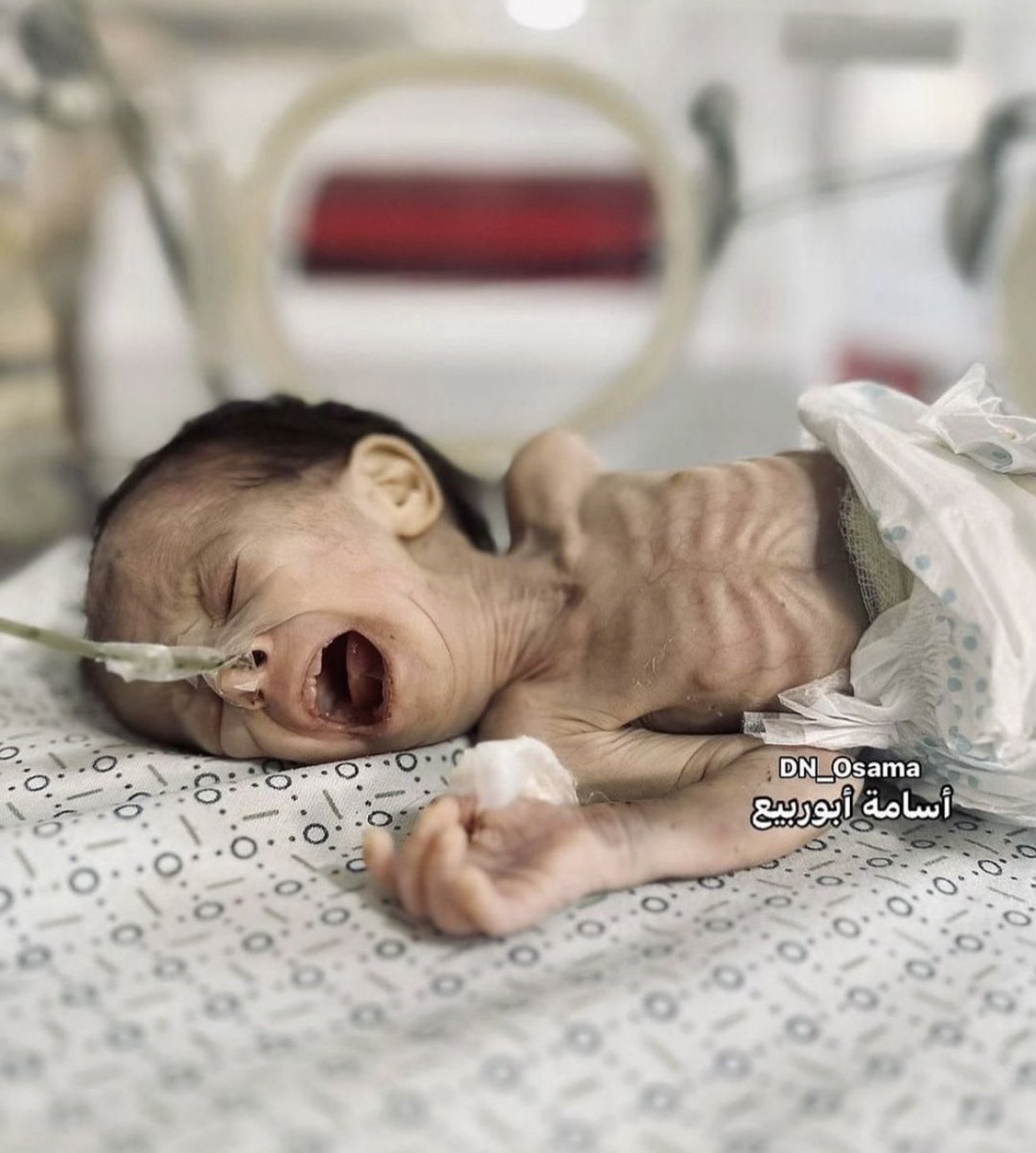 Baby girl dies of dehydration and malnutrition in north Gaza